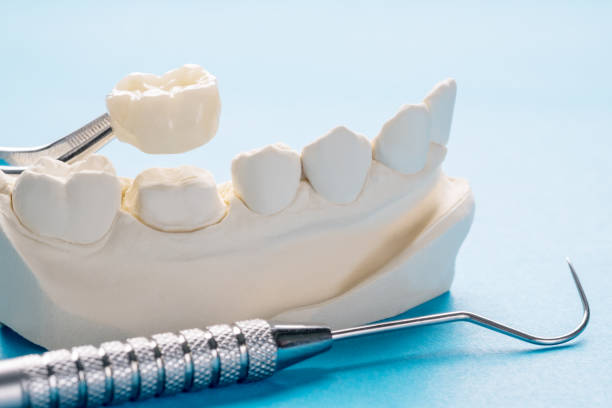 implant retained dentures